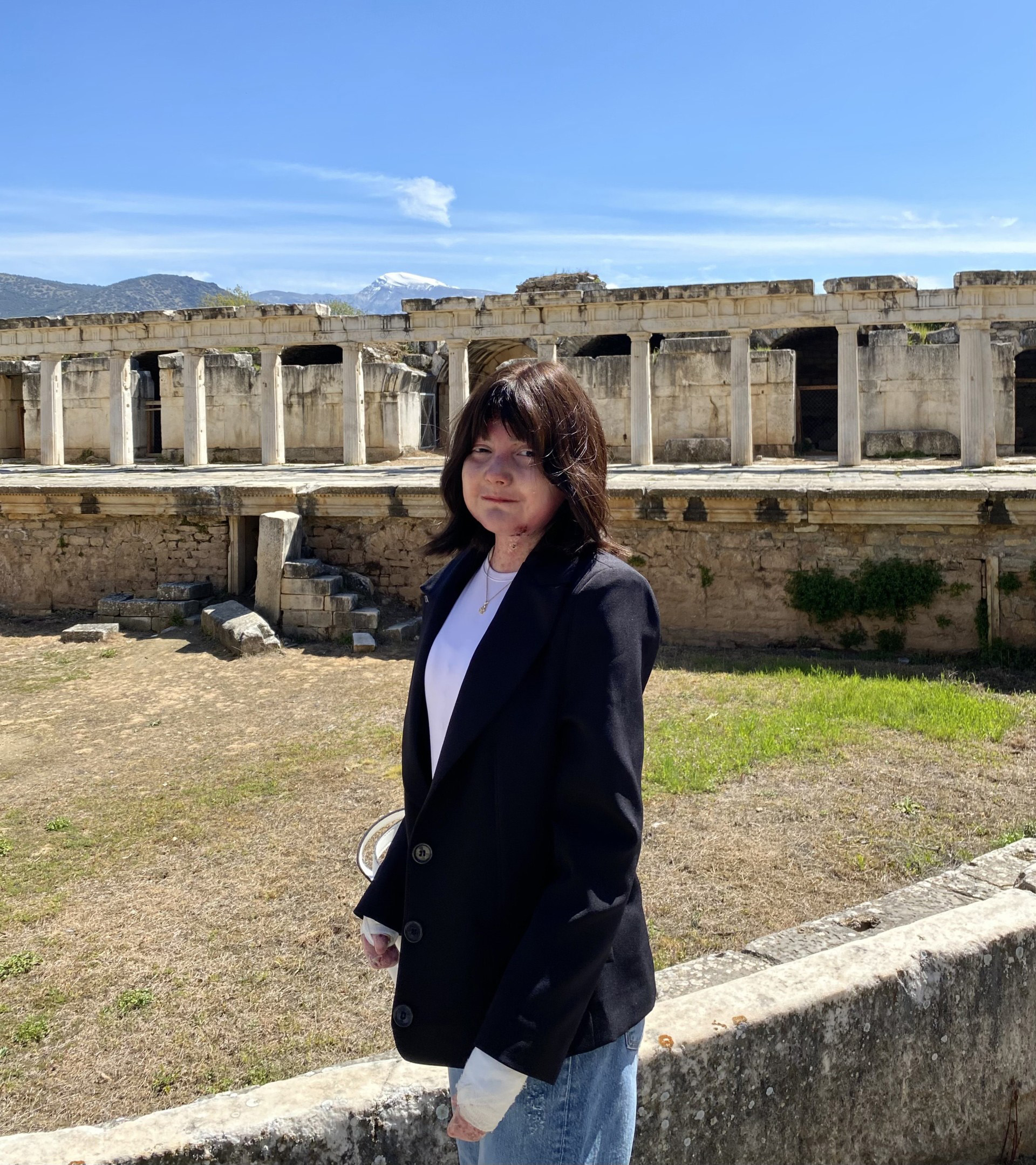 Personal Story Epidermolysis Bullosa