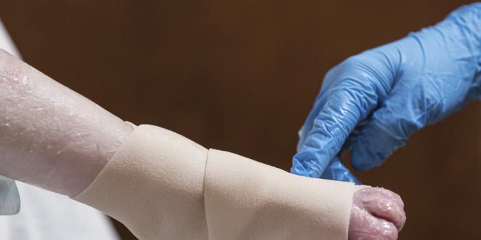 Hand and Foot Care Epidermolysis Bullosa