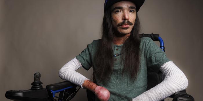 Epidermolysis Bullosa Awareness Week