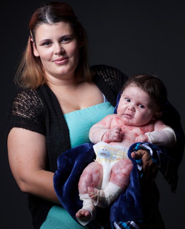 Mom with baby with EB