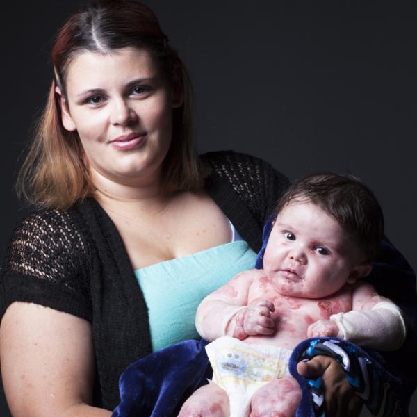 debra of America Annual Benefit Epidermolysis Bullosa