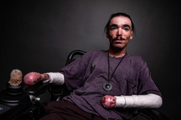 debra of America Epidermolysis Bullosa