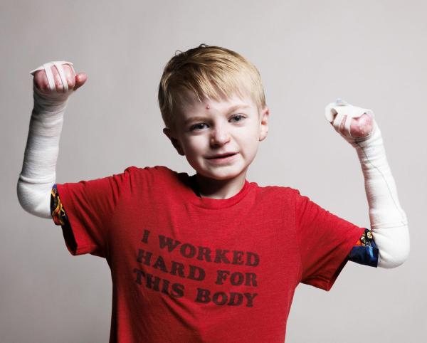 Epidermolysis Bullosa Awareness Week